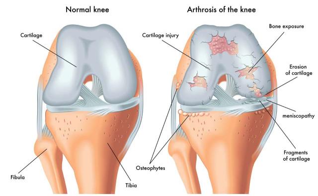 ginger-anti-inflammatory-osetoarthritis