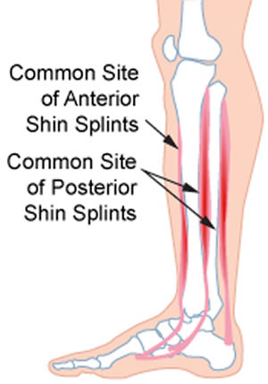 Shin Splints Picture Real Shin Splints | Real Time Pain Relief